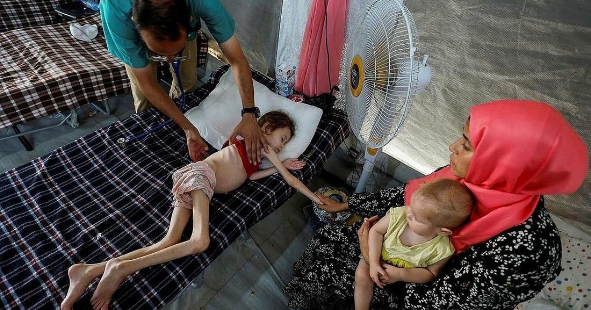الطفلة جنى عياد نازحة في دير البلح وسط قطاع غزة تعاني من وضع صحي صعب جدا، نتيجة سوء التغذية واستمرار إغلاق المعابر