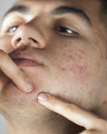 حب الشباب علامة على إصابة صحية