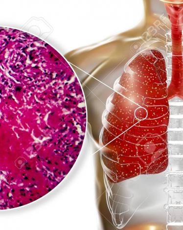 128015495-miliary-tuberculosis-3d-illustration-and-light-micrograph-showing-histopathology-of-the-lung-affecte