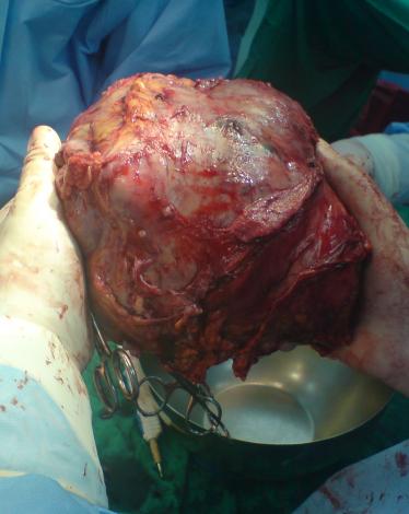 Big_Liver_Tumor