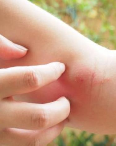 كيف تتعامل مع لدغات البعوض؟