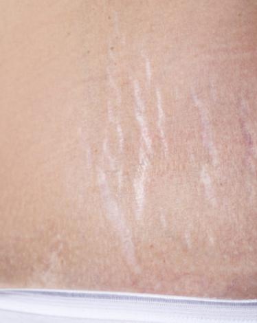 o-STRETCH-MARKS-facebook-995x498