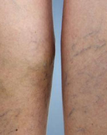 كيفية_معالجة_دوالي_الساقين