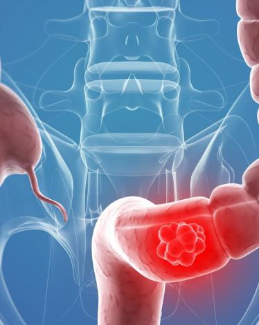 نصائح-للوقاية-من-سرطان-القولون