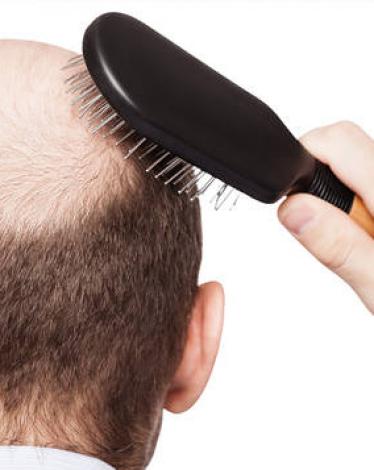 زراعة الشعر