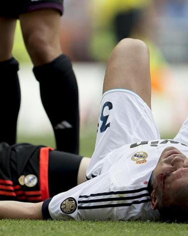 الإصابة تبعد بيبي عن ديربي مدريد والكلاسيكو