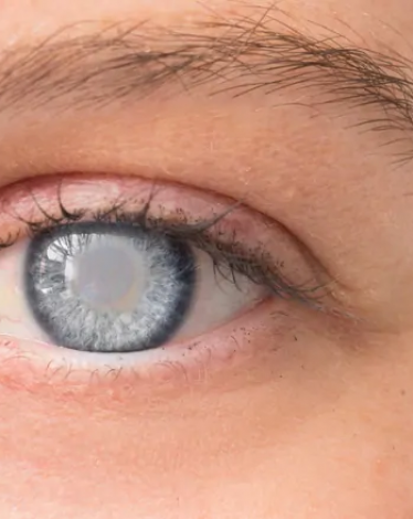 ساد العينين (أو المياه البيضاء) 