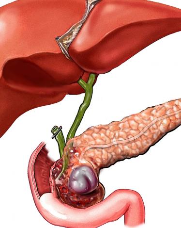 panceratitis-phta-00017179-001