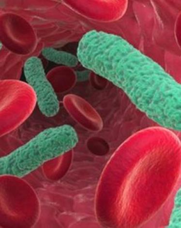_69804643_sepsis_bacterial_blood_infectionspl