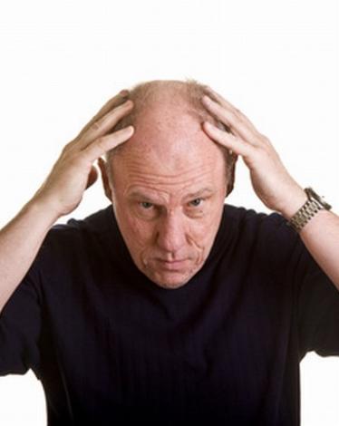Hair-Loss