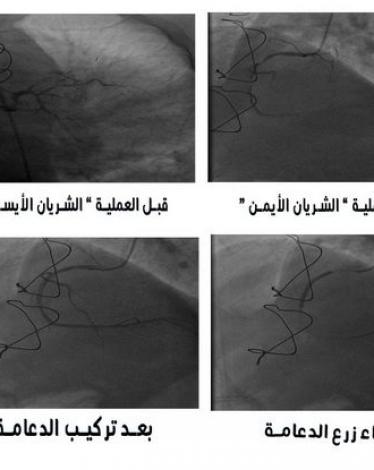 قسطرة القلب في مستشىفى الخدمة العامة