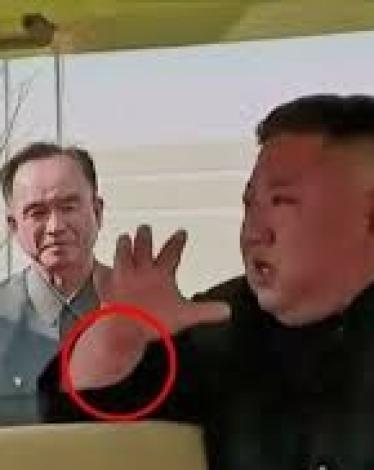 إعلام يرصد "علامة غامضة" على يد كيم جونغ أون