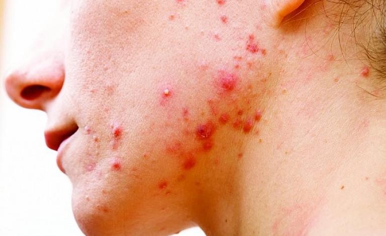 أعراض سرطان المبيض