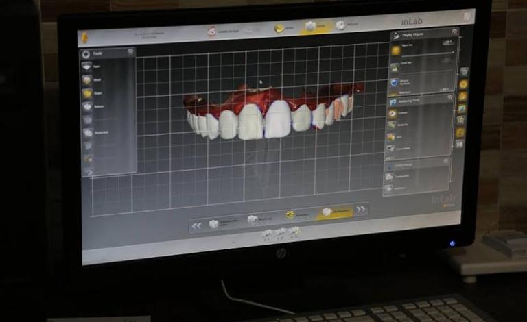 تقنية نوعية لتركيب الأسنان في غزة