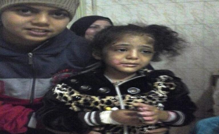 مصري يعذب طفلته حرقاً والسبب صادم