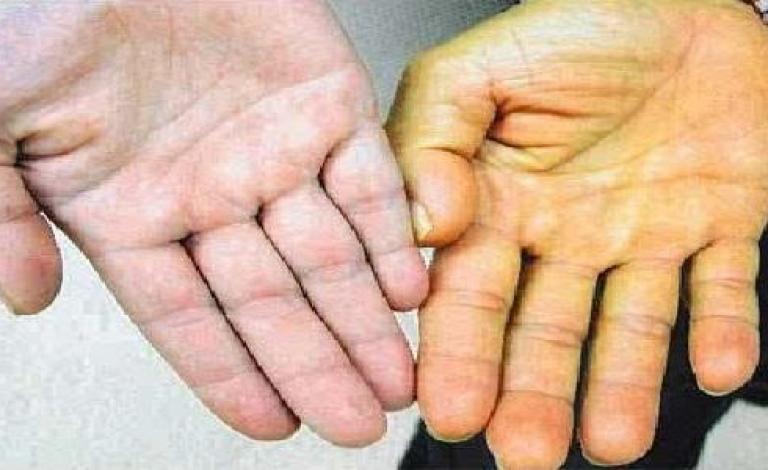 ما_هو_سبب_إصفرار_الجسم