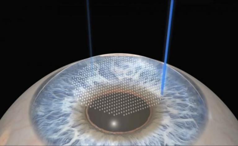 lasik_0