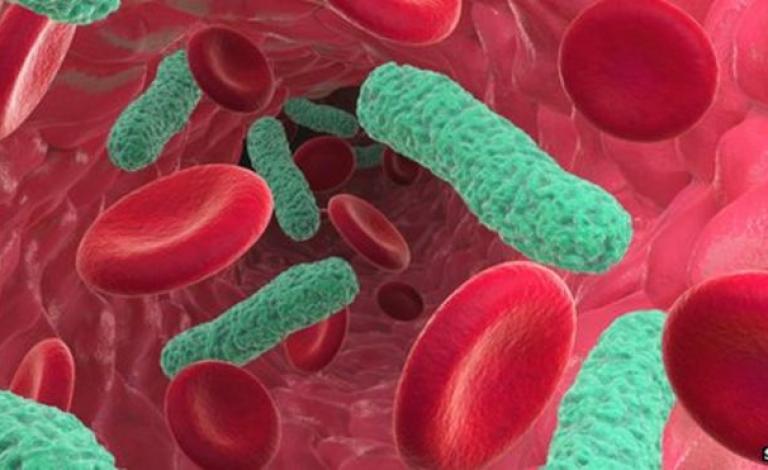 _69804643_sepsis_bacterial_blood_infectionspl