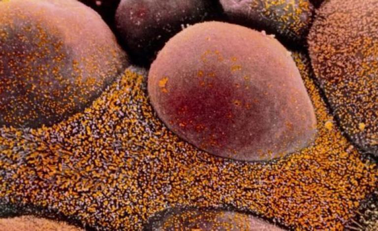 أظهر علاج موجّه جديد لسرطان المبيض 