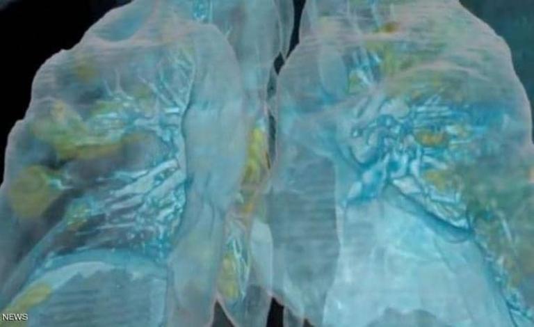 الرئة من أكثر أعضاء الجسم تضررا من كورونا