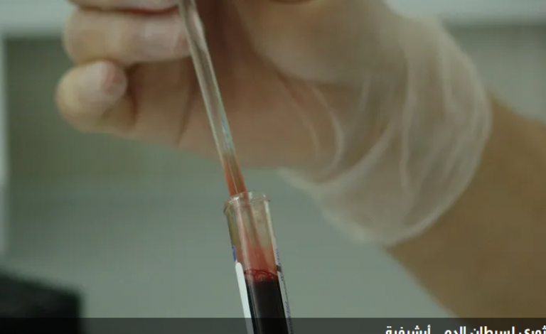 اكتشاف "تقنية ثورية" لعلاج نوع خبيث من السرطان