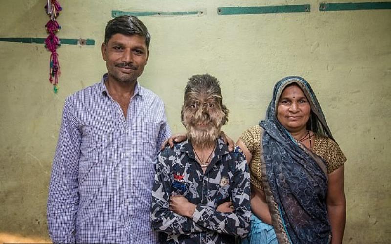 ما قصة "الطفل الذئب" في الهند؟