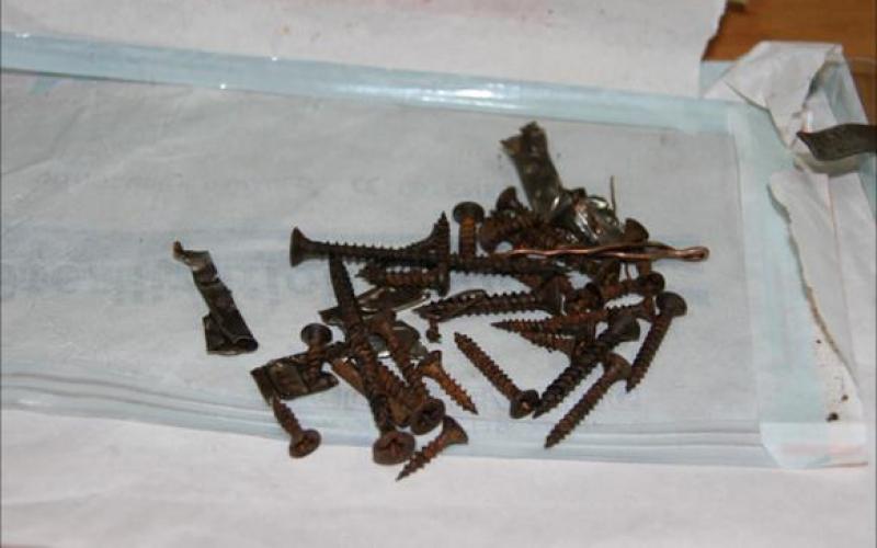 استخراج عشرات الملاعق والبراغي من بطن فلسطيني