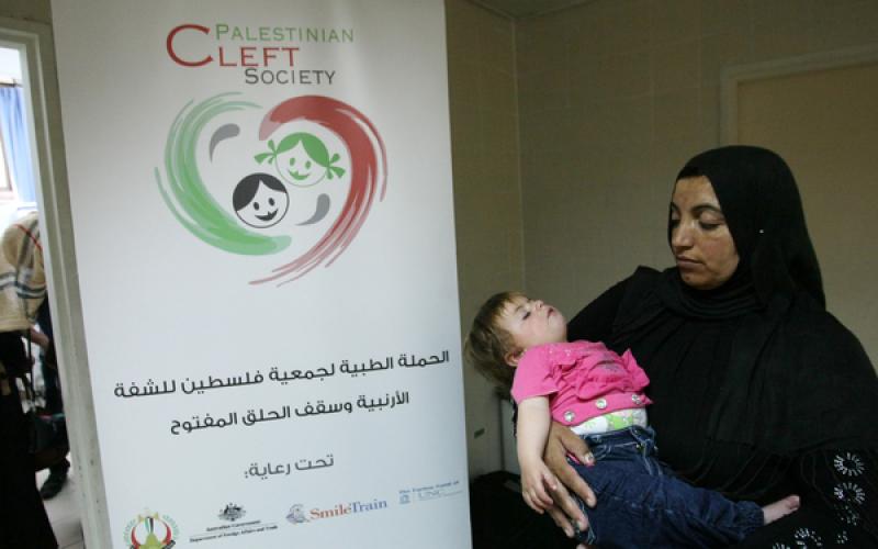 صور: عملية "الشفة الأرنبية" لطفل بالخليل