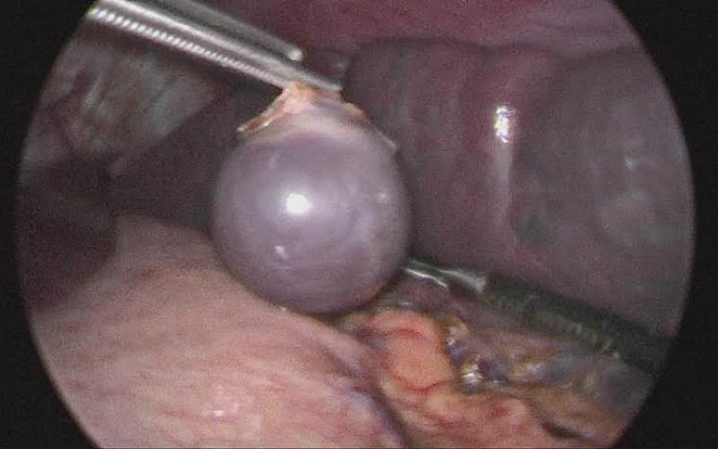 بالصور: عملية معقدة بالمنظار لطفل بغزة