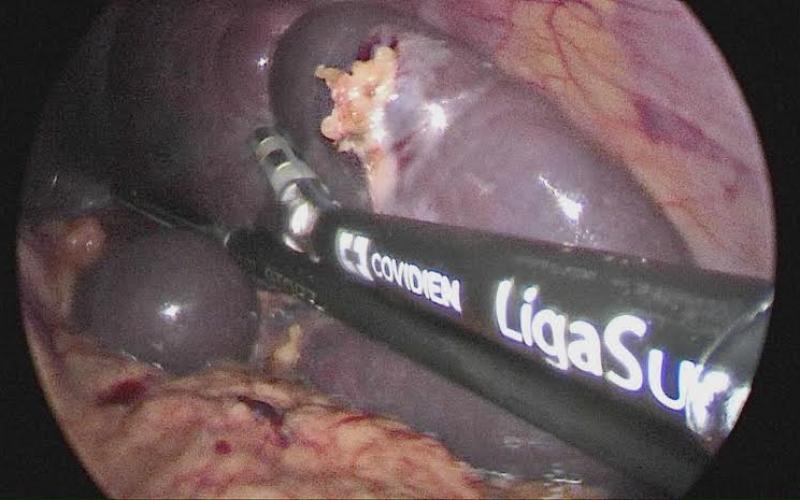 بالصور: عملية معقدة بالمنظار لطفل بغزة