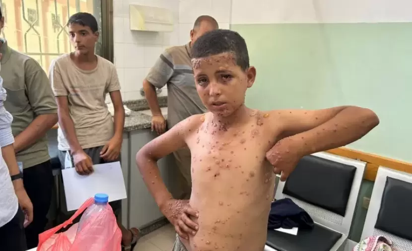 الأونروا: التهابات جلدية متزايدة بغزة نتيجة انتشار القوارض والحشرات
