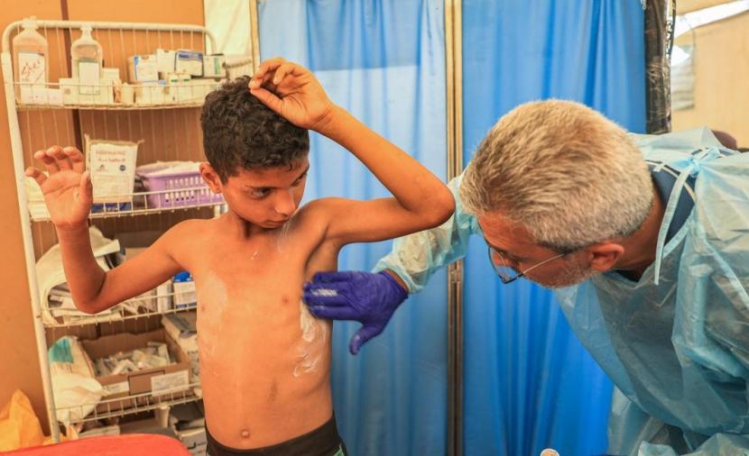 الأمم المتحدة تُحذر من تفشٍ واسع لـ "جدري الماء" يُهدد النازحين في غزة