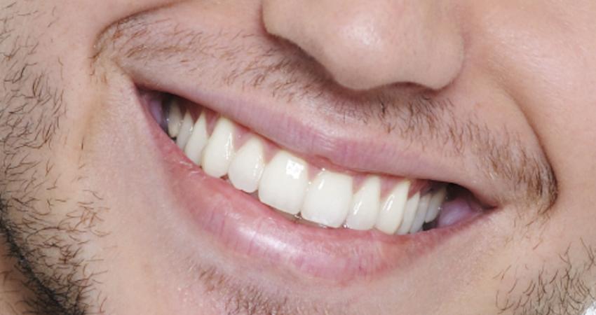 اكتشاف علاج جديد للحد من تلف الأسنان