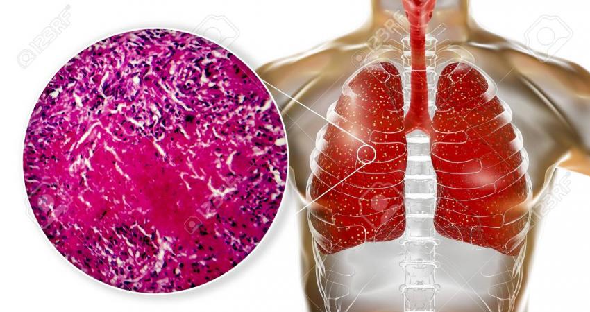 128015495-miliary-tuberculosis-3d-illustration-and-light-micrograph-showing-histopathology-of-the-lung-affecte