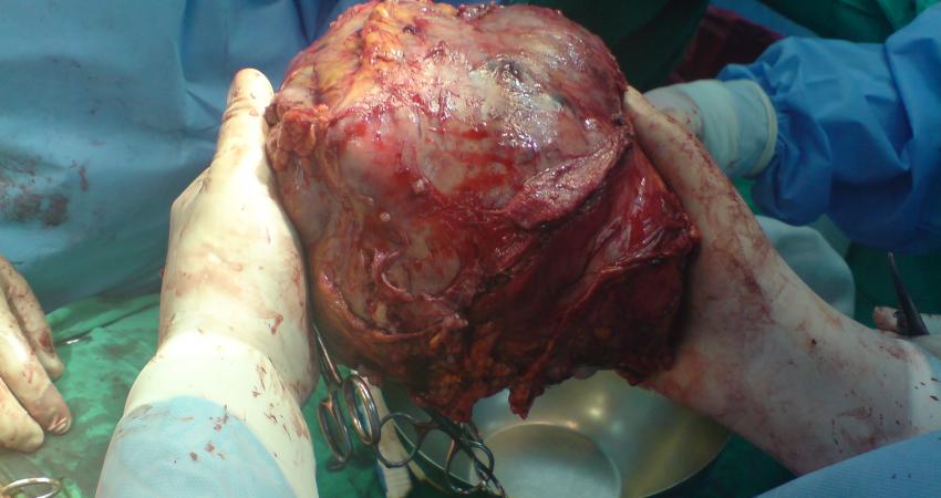 Big_Liver_Tumor