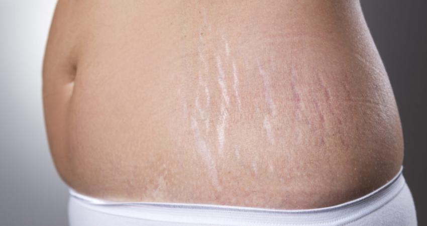 o-STRETCH-MARKS-facebook-995x498