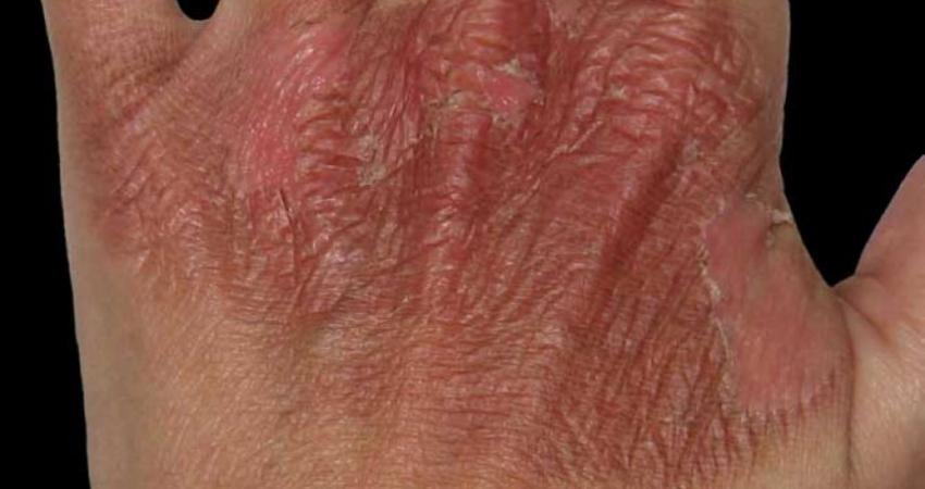 إصابة مواطنَيْن بحروق في مخيم جباليا