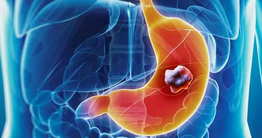 Symptoms-of-stomach-cancer