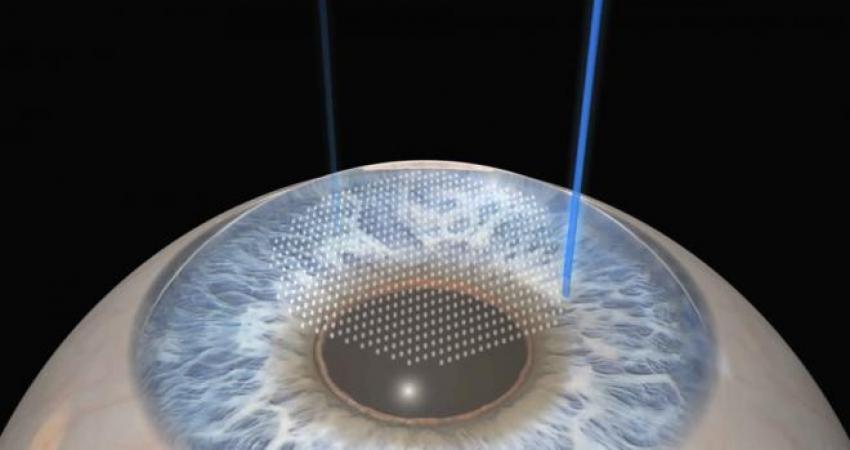 lasik_0