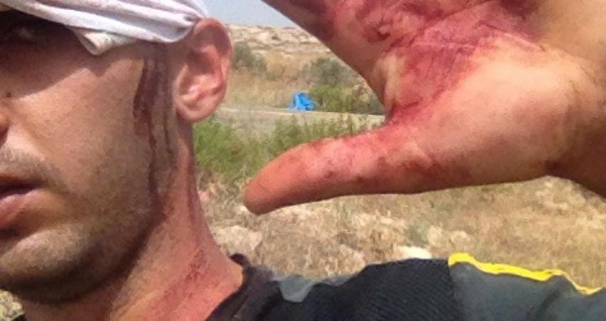 صورة اصابة شبا