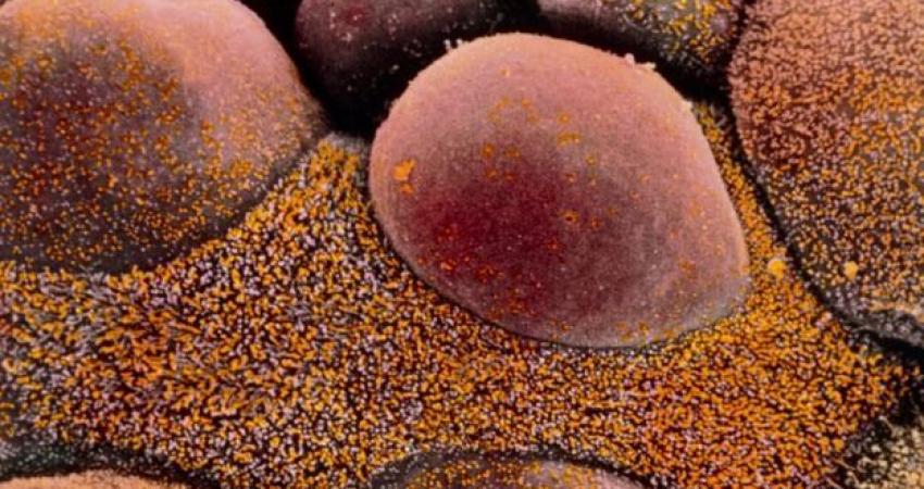 أظهر علاج موجّه جديد لسرطان المبيض 