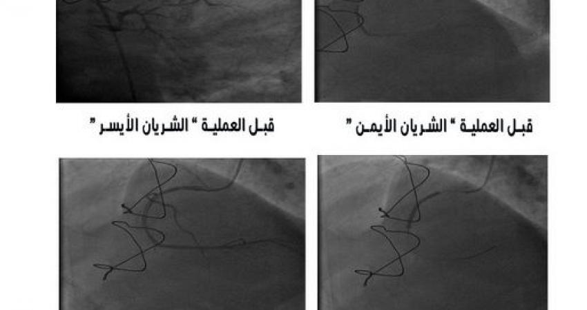 قسطرة القلب في مستشىفى الخدمة العامة
