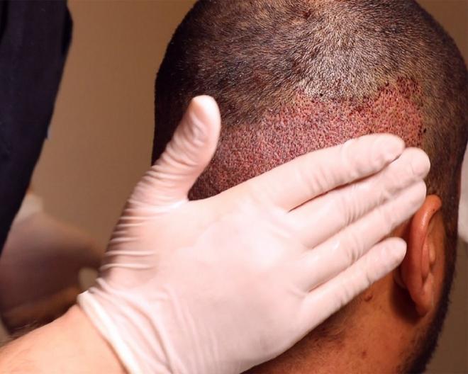 6 أنواع لـ عملية زراعة الشعر.. أحدثها بدون جراحة ولها نتائج سريعة | فلسطين  الآن